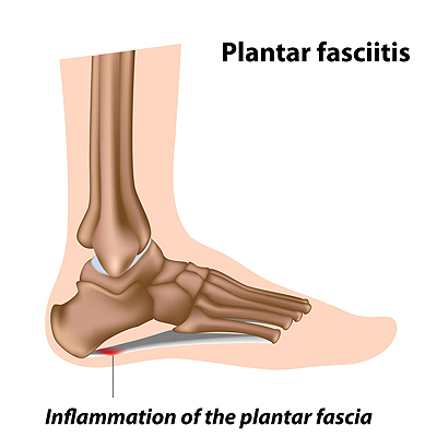 Is It Plantar Fasciitis or a Bruised Heel?