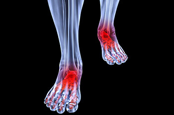 arthritic foot and ankle care treatment in the Dallas, TX 75231, Athens, TX 75751 and Gun Barrel City, TX 75156 area