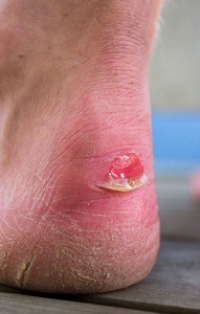 How to Treat Blisters on the Feet