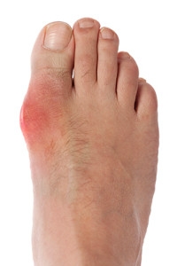Foods That Will Lessen Your Chance of Gout Development