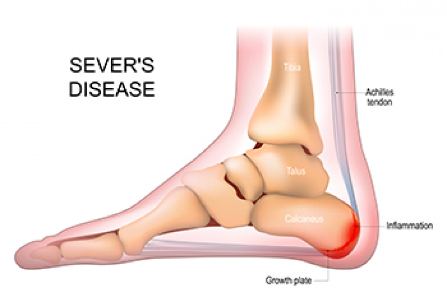 Calcaneal pain deals in child