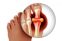 How Can Gout Attacks Be Reduced?