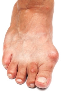 How to Treat a Bunion