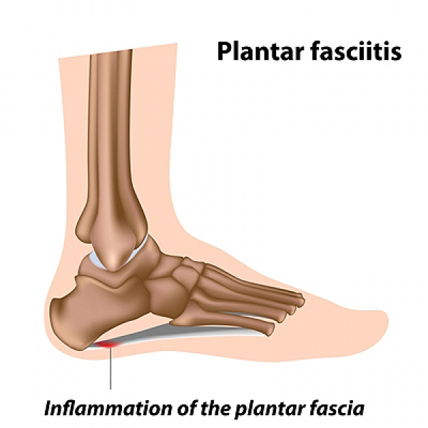 How Long Does Plantar Fasciitis Treatment Take? — Precision Foot and Ankle  Centers
