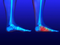 Foot Pain May Coincide With Flat Feet