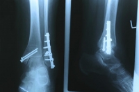 How Stress Fractures Develop and Differ From Breaks